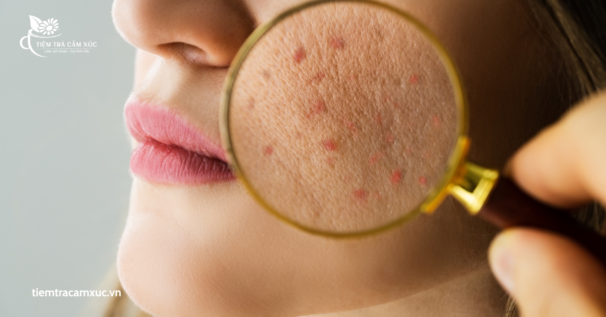 Uống trà nhiều có nổi mụn không