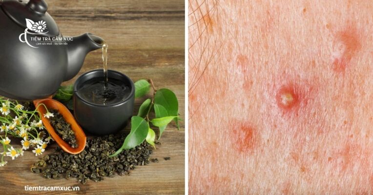 Trà có thể gây nổi mụn không 